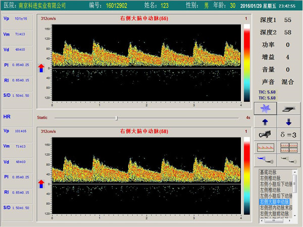 經(jīng)顱多普勒單通道，雙深度界面