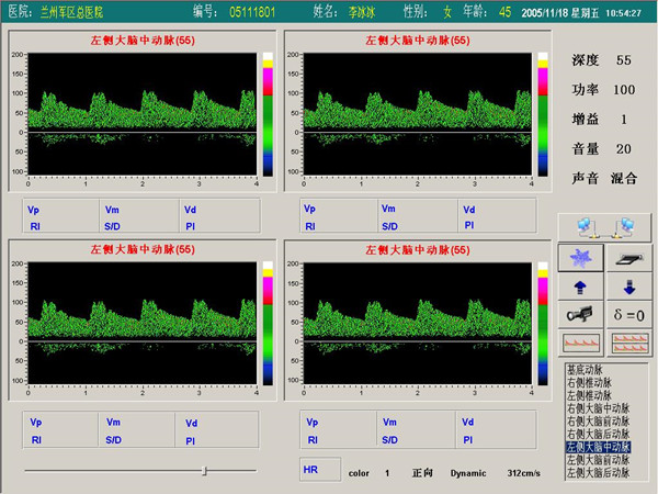 超聲經(jīng)顱多普勒血流分析儀四窗口（四深度）檢測(cè)界面.jpg