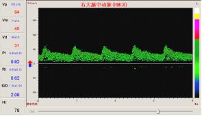 TCD檢測(cè)腦供血不足的頻譜圖像.jpg
