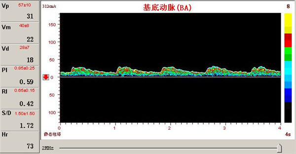 經(jīng)顱多普勒檢測椎基底動(dòng)脈供血障礙的表現(xiàn)