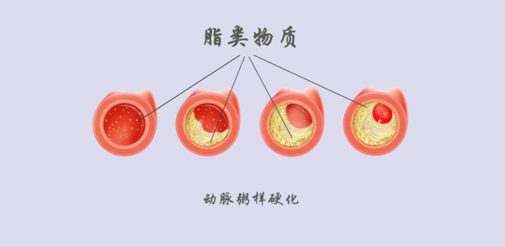 顱內(nèi)動脈粥樣硬化與缺血性腦卒中的關(guān)系