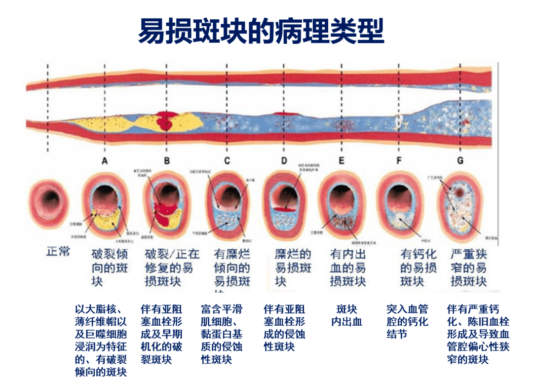 易損斑塊是缺血性卒中發(fā)生的獨立危險因素