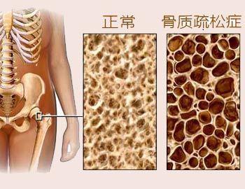 骨密度知識